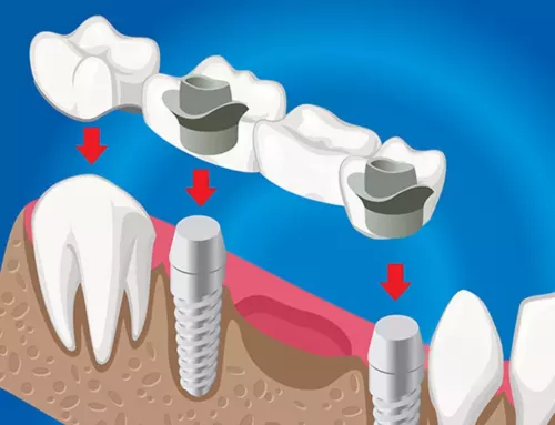 Dental Bridges: Benefits & Who Needs Them