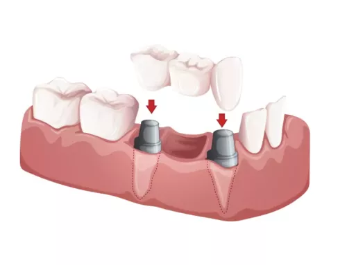 Are you a candidate for dental bridges?