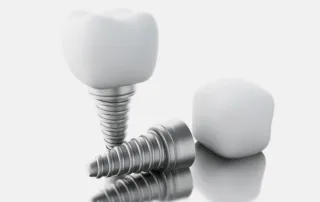 Ashburn dental implant