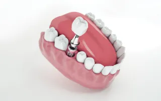Dental Implants in Ashburn